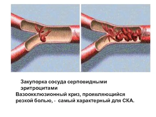 Закупорка сосуда серповидными эритроцитами Вазоокклюзионный криз, проявляющийся резкой болью, - самый характерный для СКА.