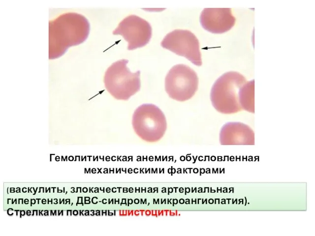 Гемолитическая анемия, обусловленная механическими факторами (васкулиты, злокачественная артериальная гипертензия, ДВС-синдром, микроангиопатия). Стрелками показаны шистоциты.