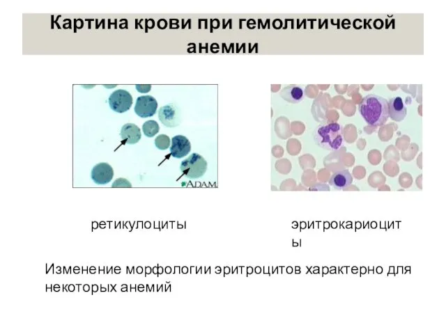 Картина крови при гемолитической анемии ретикулоциты эритрокариоциты Изменение морфологии эритроцитов характерно для некоторых анемий