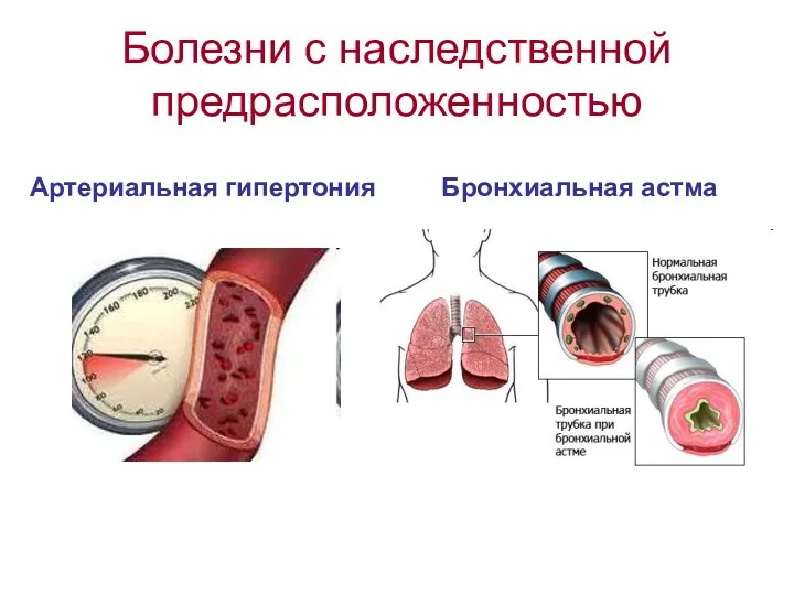 Болезни с наследственной предрасположенностью Артериальная гипертония Бронхиальная астма