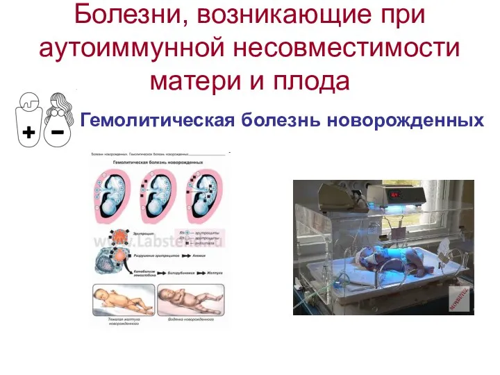 Болезни, возникающие при аутоиммунной несовместимости матери и плода Гемолитическая болезнь новорожденных