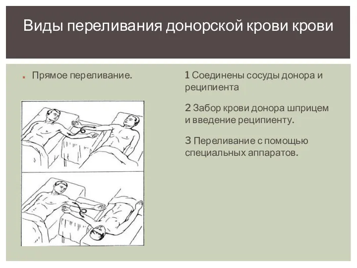 Прямое переливание. 1 Соединены сосуды донора и реципиента 2 Забор