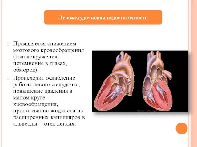 Проявляется снижением мозгового кровообращения (головокружения, потемнение в глазах, обморок). Происходит ослабление работы левого