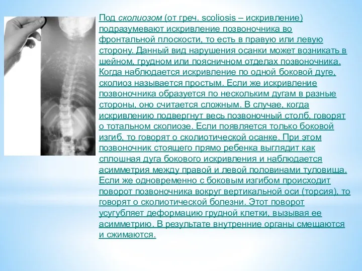 Под сколиозом (от греч. scoliosis – искривление) подразумевают искривление позвоночника