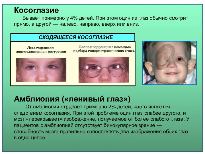 Амблиопия («ленивый глаз») От амблиопии страдает примерно 2% детей, часто является следствием косоглазия.