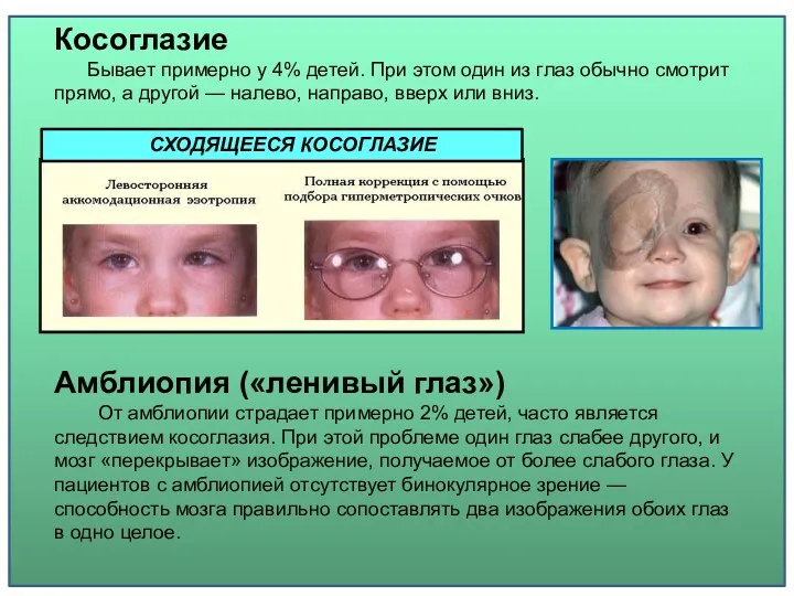 Амблиопия («ленивый глаз») От амблиопии страдает примерно 2% детей, часто
