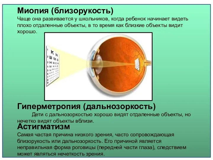 Миопия (близорукость) Чаще она развивается у школьников, когда ребенок начинает видеть плохо отдаленные