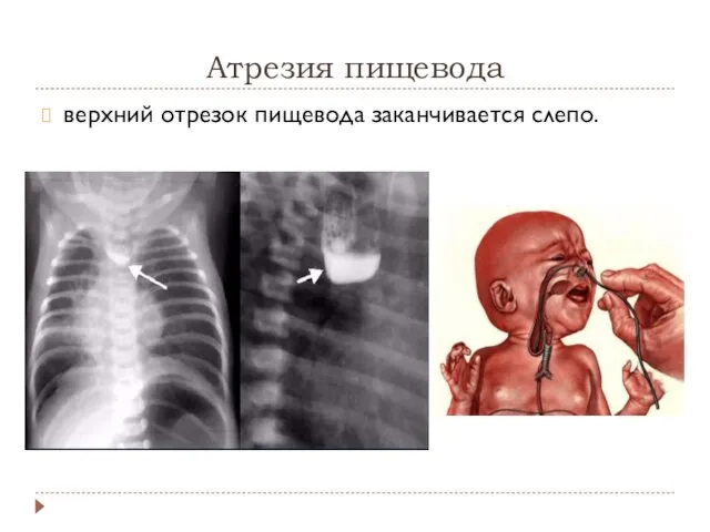 Атрезия пищевода верхний отрезок пищевода заканчивается слепо.