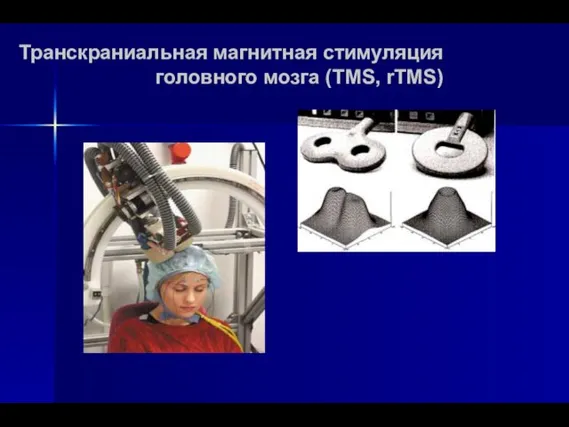 Транскраниальная магнитная стимуляция головного мозга (TMS, rTMS)