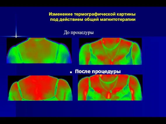 Изменение термографической картины под действием общей магнитотерапии После процедуры До процедуры