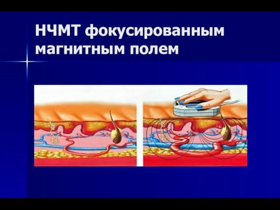 НЧМТ фокусированным магнитным полем