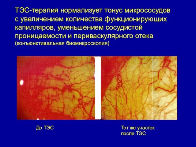 ТЭС-терапия нормализует тонус микрососудов с увеличением количества функционирующих капилляров, уменьшением