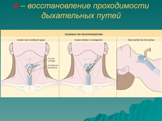 A – восстановление проходимости дыхательных путей