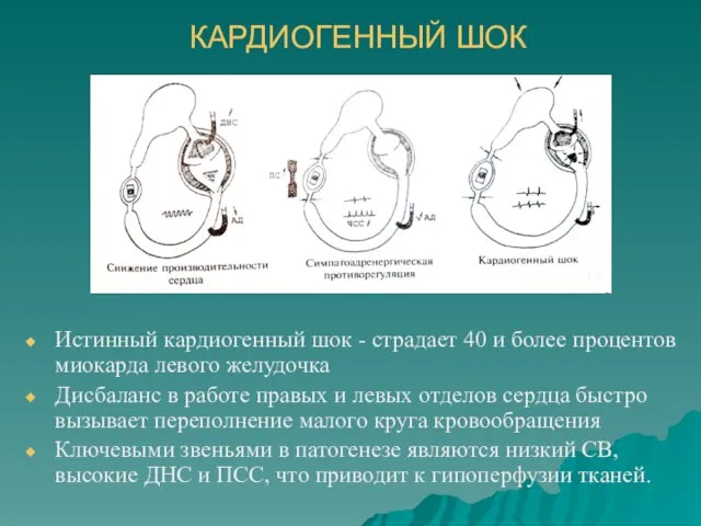 КАРДИОГЕННЫЙ ШОК Истинный кардиогенный шок - страдает 40 и более процентов миокарда левого