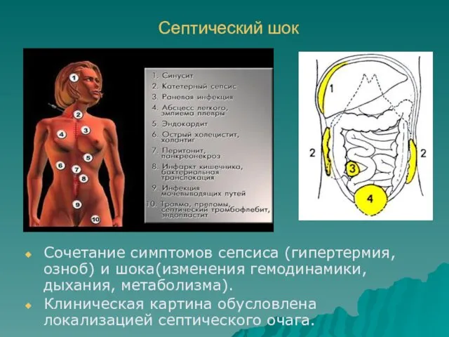 Септический шок Сочетание симптомов сепсиса (гипертермия, озноб) и шока(изменения гемодинамики,