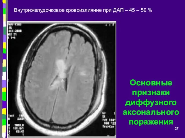 Основные признаки диффузного аксонального поражения Внутрижелудочковое кровоизлияние при ДАП – 45 – 50 %