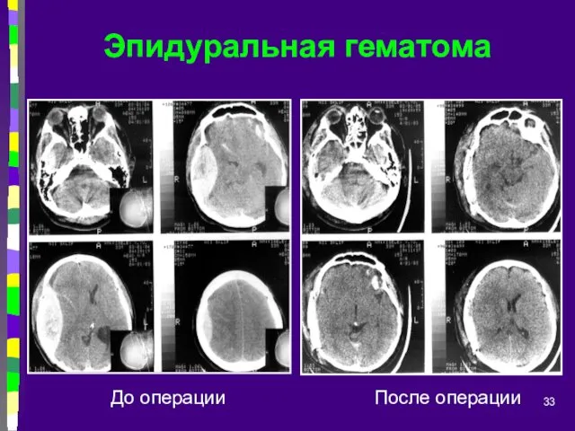 Эпидуральная гематома До операции После операции