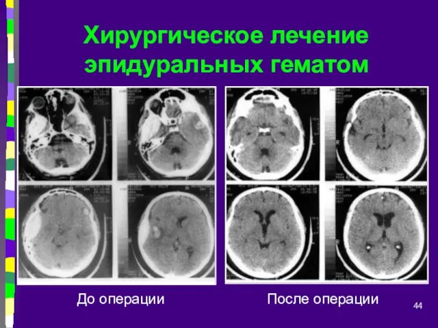 Хирургическое лечение эпидуральных гематом До операции После операции