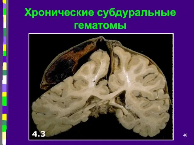 Хронические субдуральные гематомы