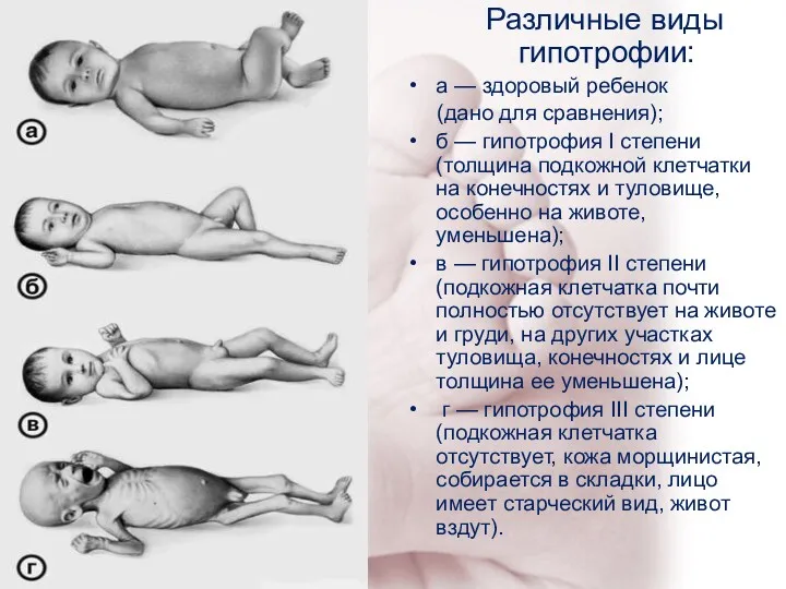 Различные виды гипотрофии: а — здоровый ребенок (дано для сравнения);