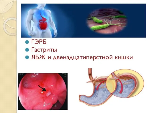 ГЭРБ Гастриты ЯБЖ и двенадцатиперстной кишки