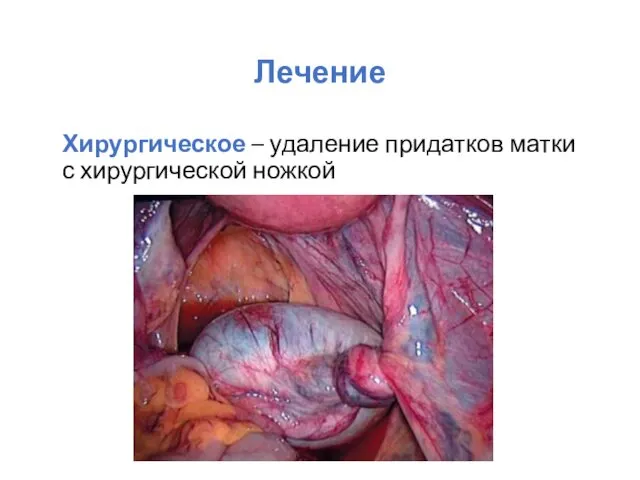 Лечение Хирургическое – удаление придатков матки с хирургической ножкой