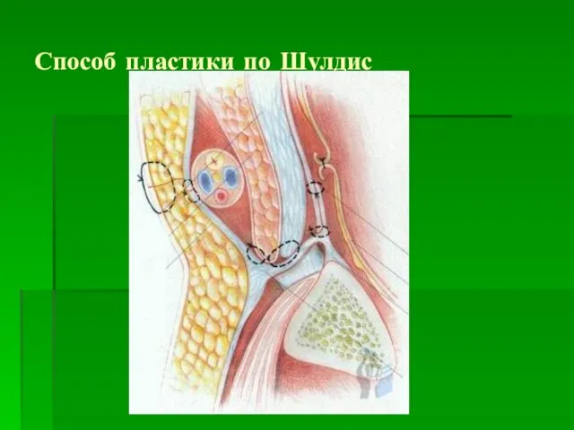 Способ пластики по Шулдис