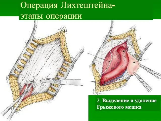 1. Вскрытие пахового канала 2. Выделение и удаление Грыжевого мешка Операция Лихтештейна- этапы операции