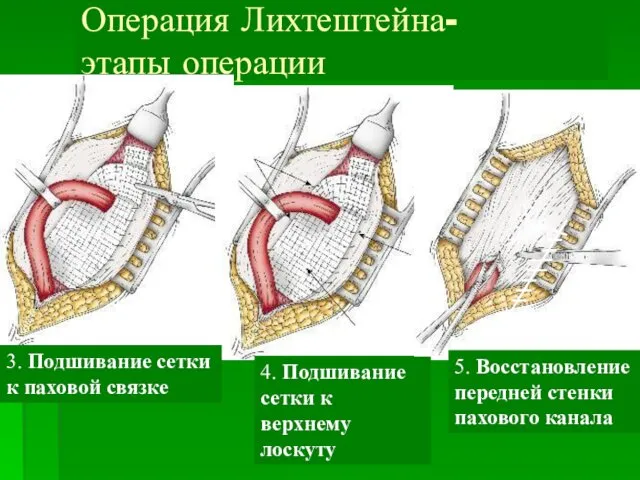 Операция Лихтештейна- этапы операции 3. Подшивание сетки к паховой связке