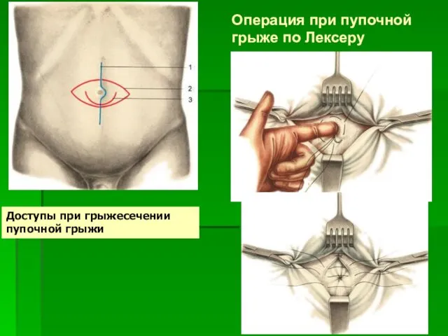 Операция при пупочной грыже по Лексеру Доступы при грыжесечении пупочной грыжи