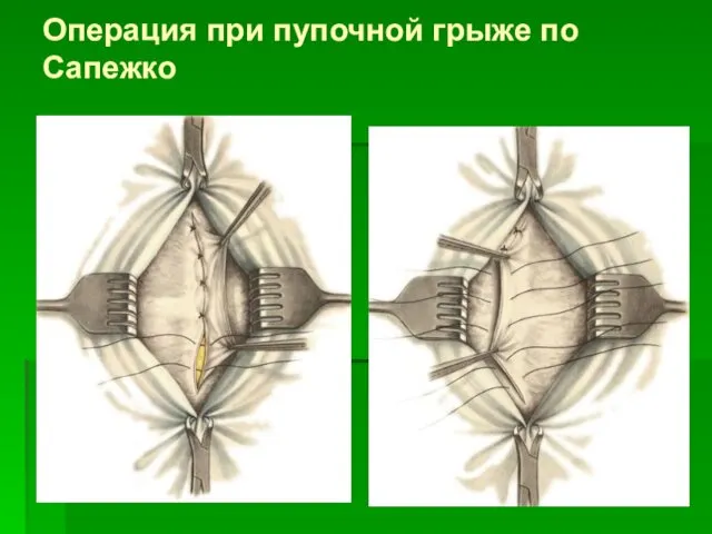 Операция при пупочной грыже по Сапежко