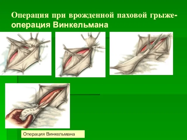 Операция при врожденной паховой грыже- операция Винкельмана Операция Винкельмана