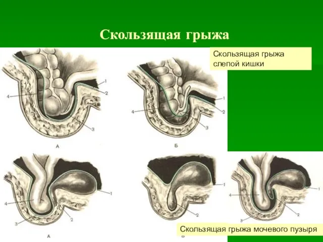 Скользящая грыжа Скользящая грыжа слепой кишки Скользящая грыжа мочевого пузыря