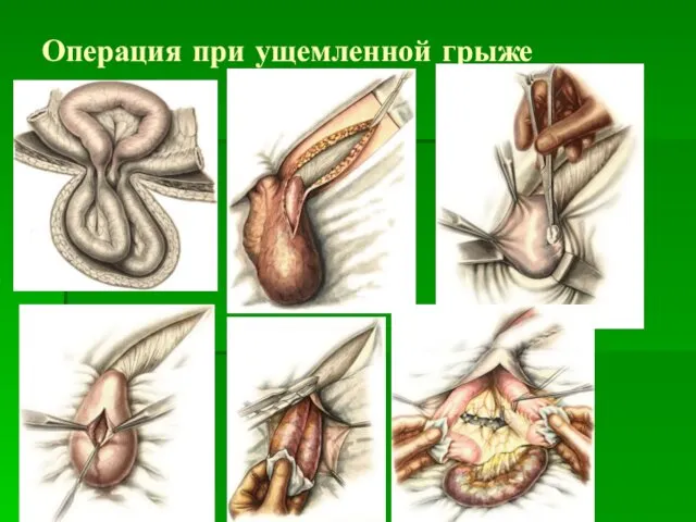 Операция при ущемленной грыже