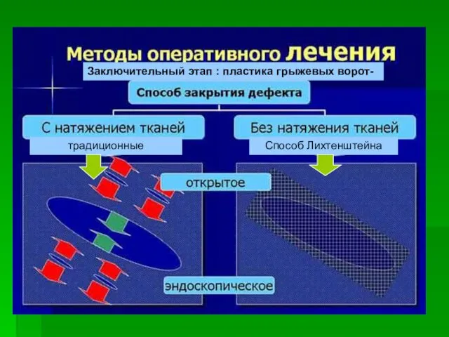 традиционные Способ Лихтенштейна Заключительный этап : пластика грыжевых ворот-