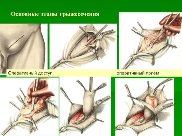 Основные этапы грыжесечения Оперативный доступ оперативный прием