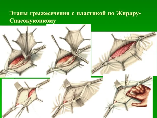 Этапы грыжесечения с пластикой по Жирару-Спасокукоцкому