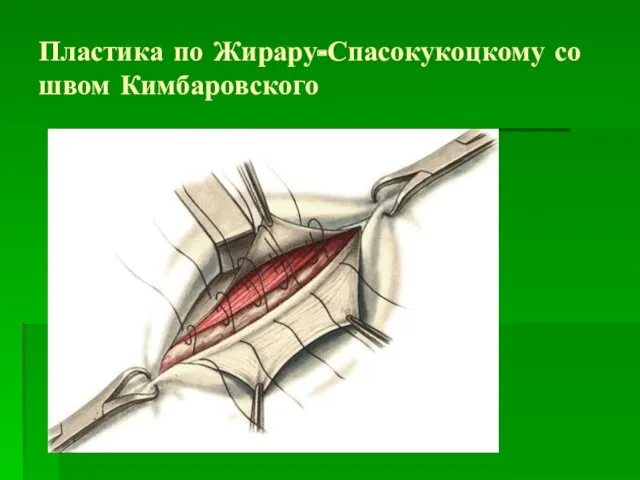 Пластика по Жирару-Спасокукоцкому со швом Кимбаровского