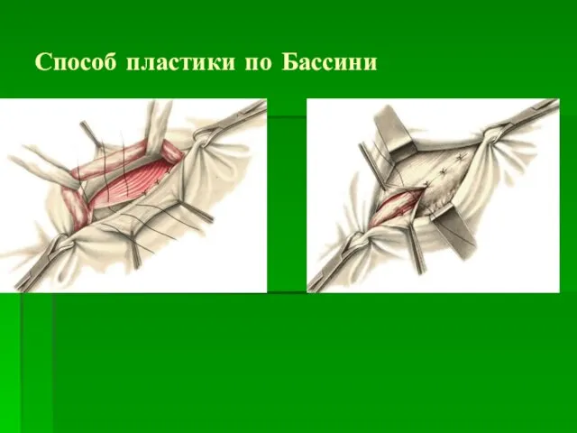 Способ пластики по Бассини