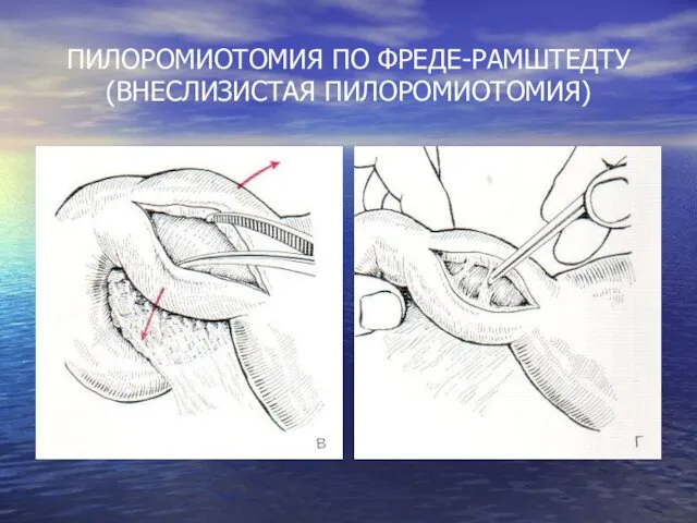 ПИЛОРОМИОТОМИЯ ПО ФРЕДЕ-РАМШТЕДТУ (ВНЕСЛИЗИСТАЯ ПИЛОРОМИОТОМИЯ)