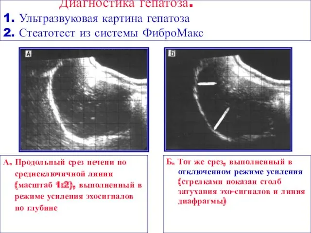 Диагностика гепатоза. 1. Ультразвуковая картина гепатоза 2. Стеатотест из системы