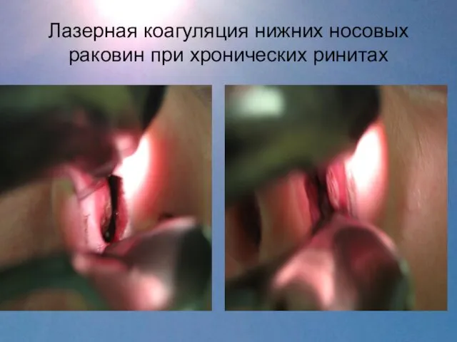 Лазерная коагуляция нижних носовых раковин при хронических ринитах