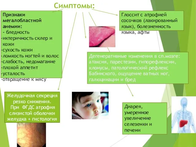 Симптомы: Признаки мегалобластной анемии: - бледность иктеричность склер и кожи