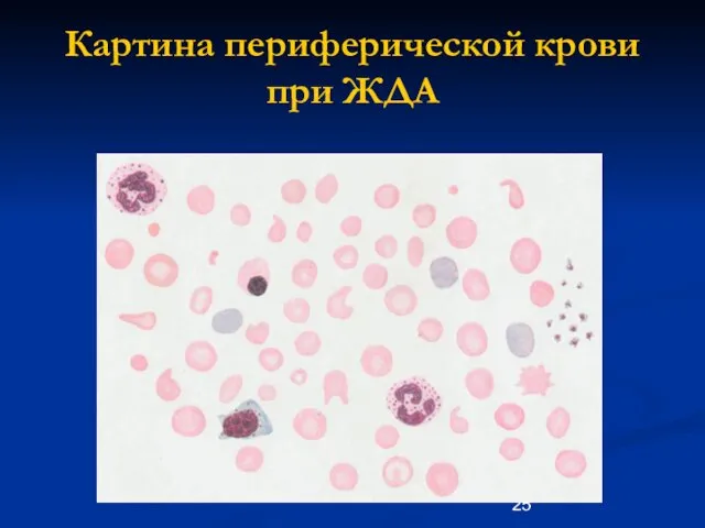 Картина периферической крови при ЖДА