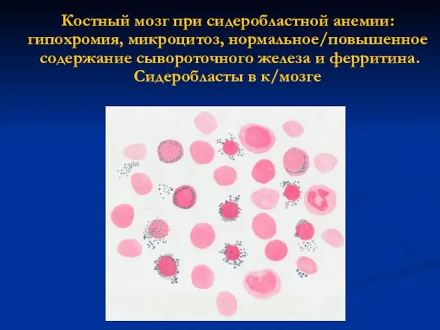 Костный мозг при сидеробластной анемии: гипохромия, микроцитоз, нормальное/повышенное содержание сывороточного железа и ферритина. Сидеробласты в к/мозге