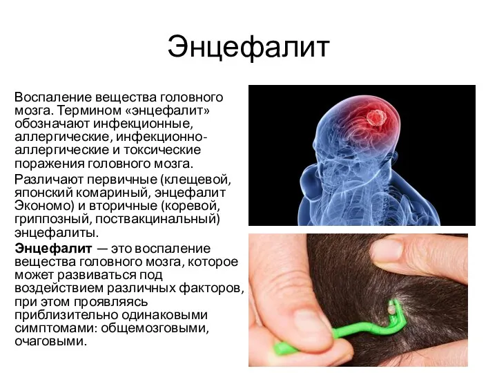 Энцефалит Воспаление вещества головного мозга. Термином «энцефалит» обозначают инфекционные, аллергические,