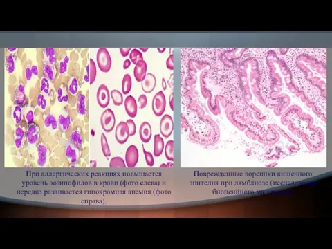 При аллергических реакциях повышается уровень эозинофилов в крови (фото слева) и нередко развивается