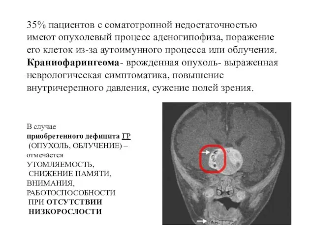 35% пациентов с соматотропной недостаточностью имеют опухолевый процесс аденогипофиза, поражение