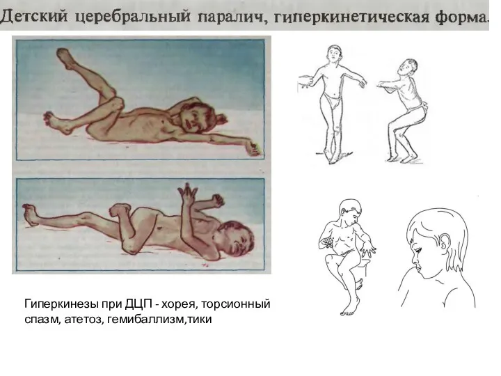 Гиперкинезы при ДЦП - хорея, торсионный спазм, атетоз, гемибаллизм,тики