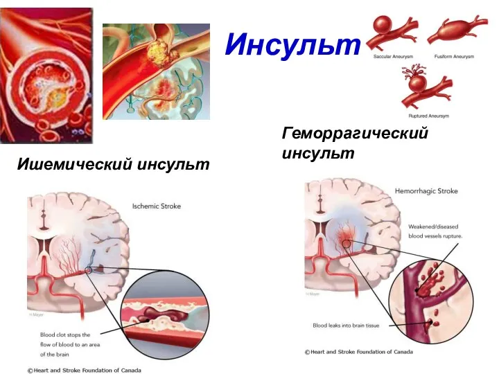 Ишемический инсульт Геморрагический инсульт Инсульт